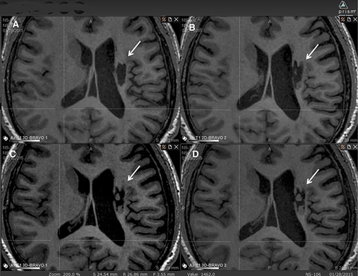 图2:腔内组织生长的纵向MRI示例。 图2:腔内组织生长的纵向MRI示例。