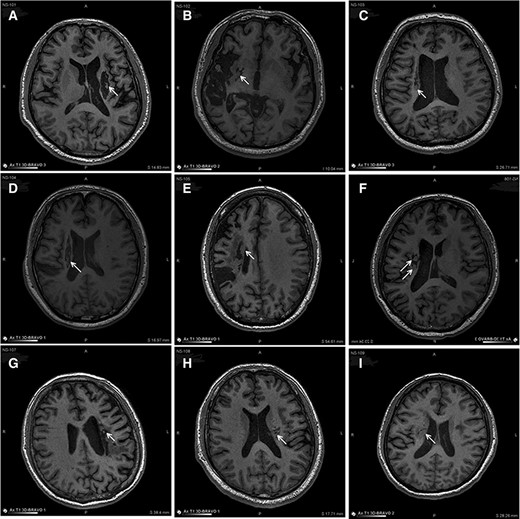 图3:NSI-566移植后最新随访时梗塞部位的MRI。 图3:NSI-566移植后最新随访时梗塞部位的MRI。