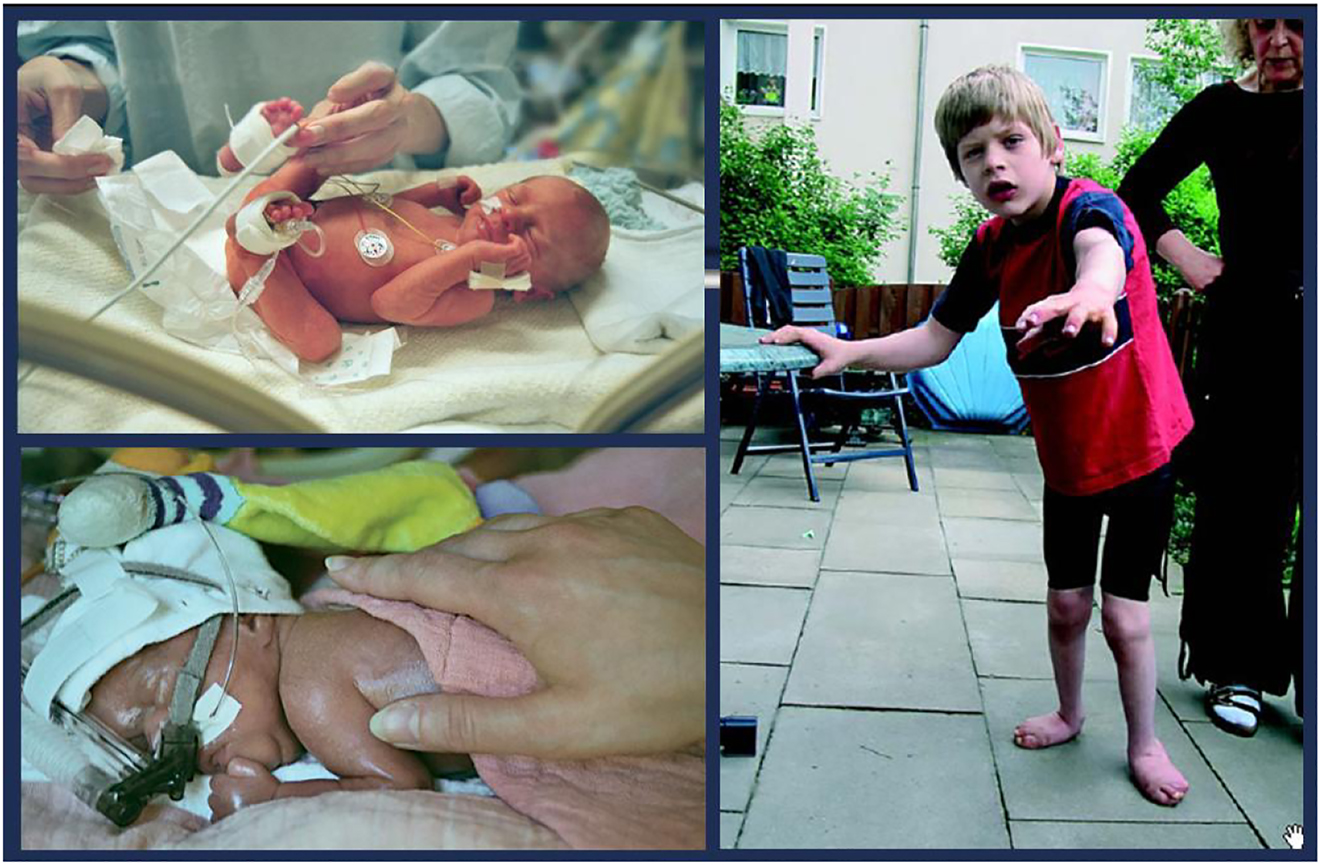 脑瘫 (CP) 是儿童期最常见的残疾，是一种严重的非进行性婴幼儿脑部疾病，具有终身后遗症