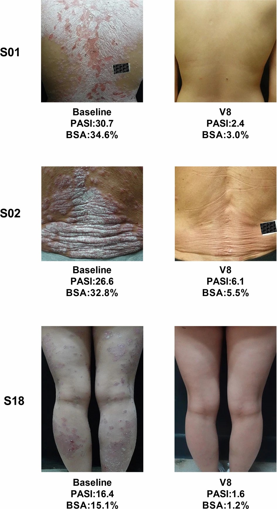 三名患者经过治疗后根据 PGA 评分显示无疾病迹象(评分为 0)或轻微疾病(评分为 1)。 三名患者经过治疗后根据 PGA 评分显示无疾病迹象(评分为 0)或轻微疾病(评分为 1)。