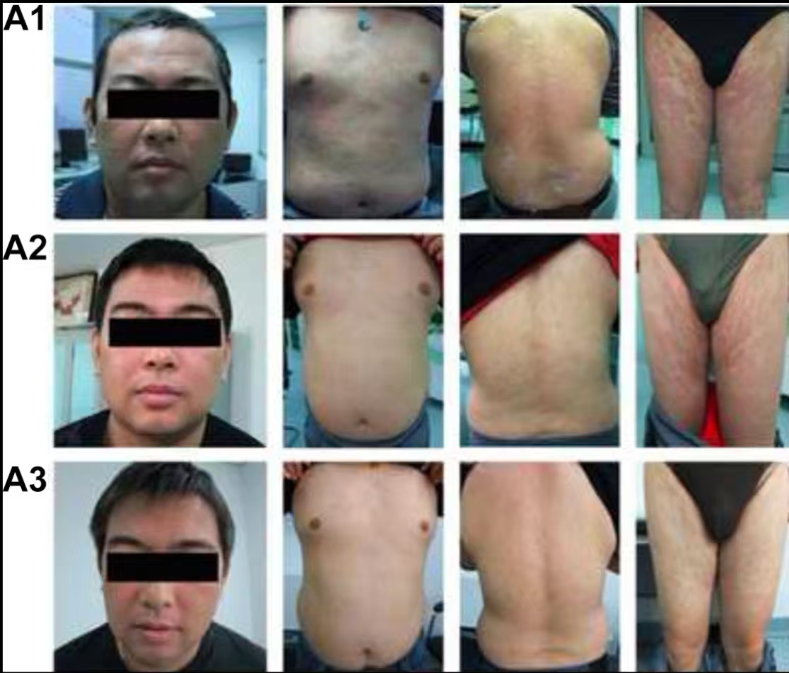 图A1是患者治疗前的皮肤情况 图A2是患者治疗6个月之后的皮肤情况 图A3是患者治疗12个月之后的皮肤情况 图A1是患者治疗前的皮肤情况
图A2是患者治疗6个月之后的皮肤情况
图A3是患者治疗12个月之后的皮肤情况