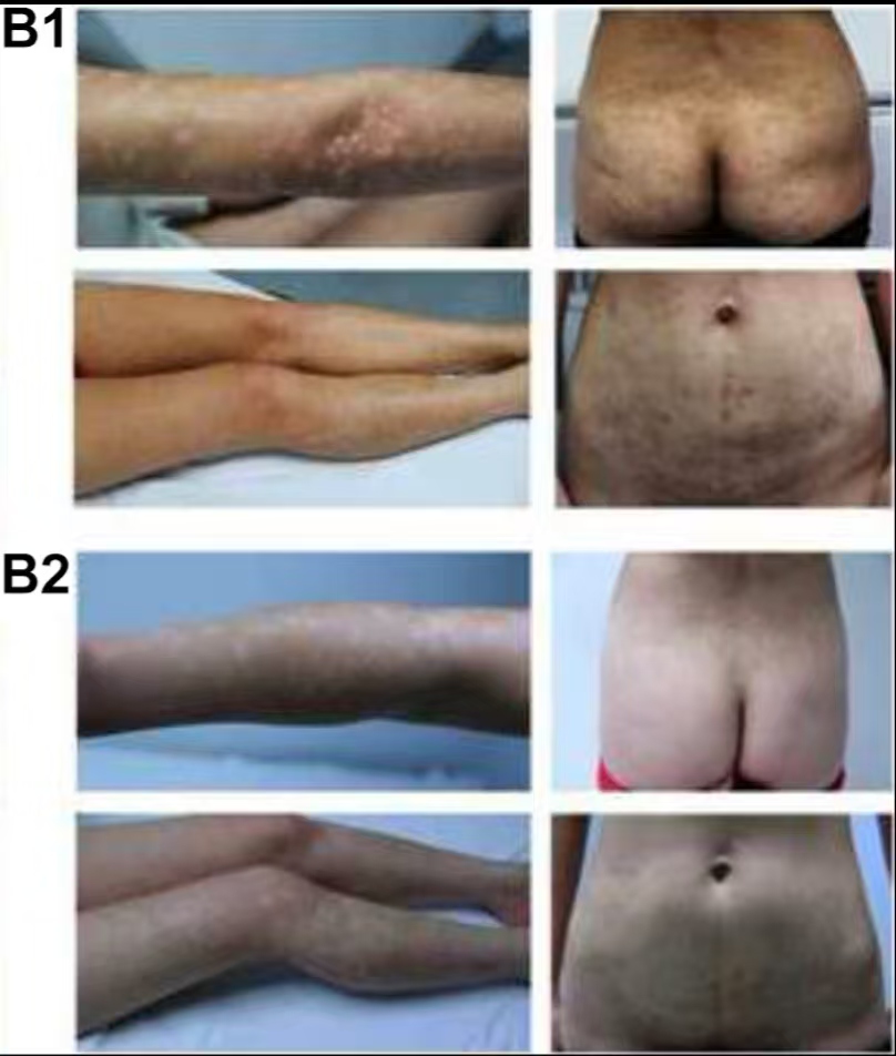 (图B1)患者入院后体检发现,患者全身遍布橙红色斑块,上面覆有银色鳞屑 (图B2)治疗初期,我院给予患者3次脐带间充质干细胞(每次1×10 6 /Kg),连续3周回输,患者全身表面逐渐恢复光滑 (图B1)患者入院后体检发现,患者全身遍布橙红色斑块,上面覆有银色鳞屑
(图B2)治疗初期,我院给予患者3次脐带间充质干细胞,连续3周回输,患者全身表面逐渐恢复光滑