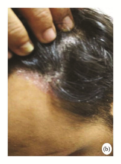骨髓间充质干细胞 治疗前,患者头皮上出现大量红斑,并附着银色鳞片(b)。 骨髓间充质干细胞 治疗前,患者头皮上出现大量红斑,并附着银色鳞片(b)。