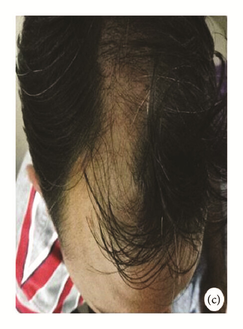 局部应用骨髓间充质干细胞一个月后,银屑病消退,炎性红斑完全清除(c)。 局部应用骨髓间充质干细胞一个月后,银屑病消退,炎性红斑完全清除(c)。