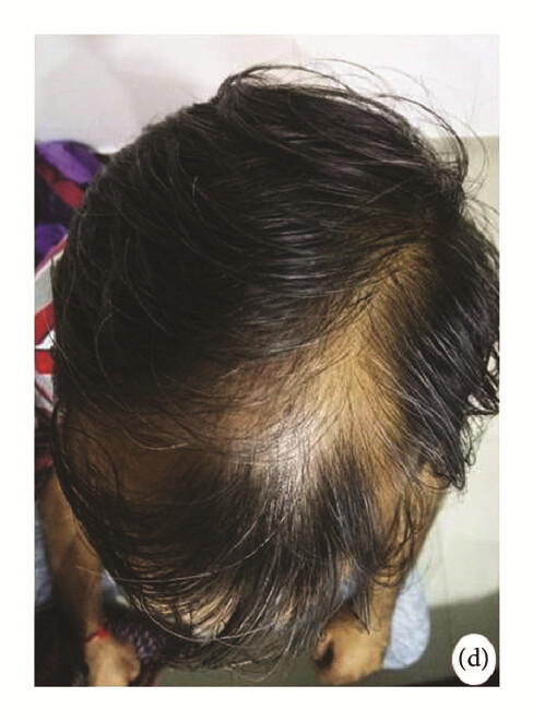 局部应用骨髓间充质干细胞一个月后,银屑病消退,炎性红斑完全清除(d)。 局部应用骨髓间充质干细胞一个月后,银屑病消退,炎性红斑完全清除(d)。