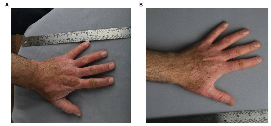 患者3细胞移植6个月后,注射部位的红斑、脱屑和厚度明显减少。皮肤厚度从2.1毫米减少到1.7毫米,与手部健康部位相似。该患者报告生活质量有所提高。PASI评分在注射细胞后从4.7变为4.3。 患者3细胞移植6个月后,注射部位的红斑、脱屑和厚度明显减少。皮肤厚度从2.1毫米减少到1.7毫米,与手部健康部位相似。该患者报告生活质量有所提高。PASI评分在注射细胞后从4.7变为4.3。