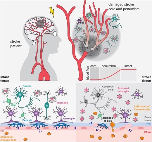 图1：中风的病理生理学