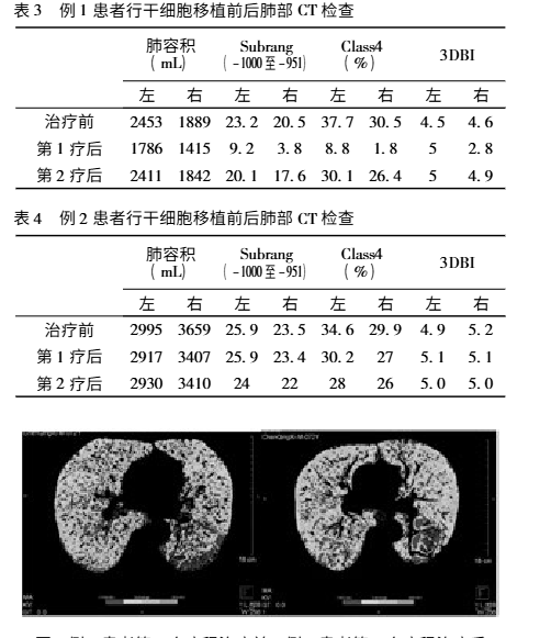 干细胞移植前后的肺部CT检查对比
