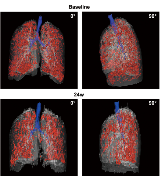 患者 #2902 自体 P63 细胞移植前和后 24 周连续肺部 CT 图像的三维可视化。