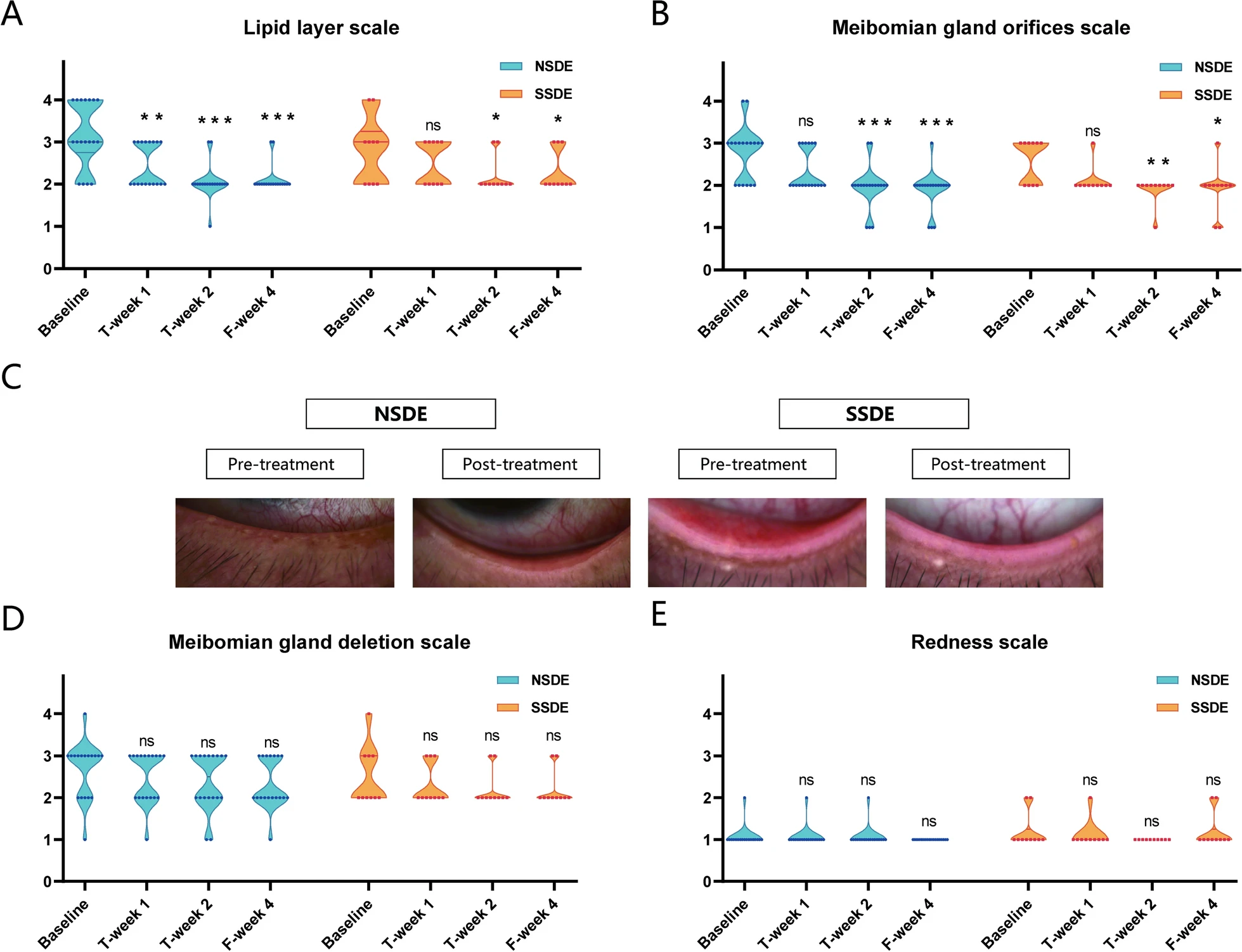 图3:NSDE和SSDE组基线、T第1周、T第2周和F第4周的脂质层、睑板腺和红斑量表。 图3:NSDE和SSDE组基线、T第1周、T第2周和F第4周的脂质层、睑板腺和红斑量表。
