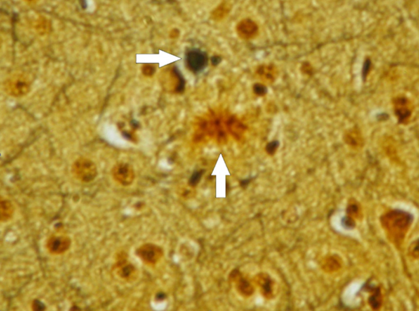 图4：本图描绘了三重转基因小鼠模型中阿尔茨海默病的病理特征。