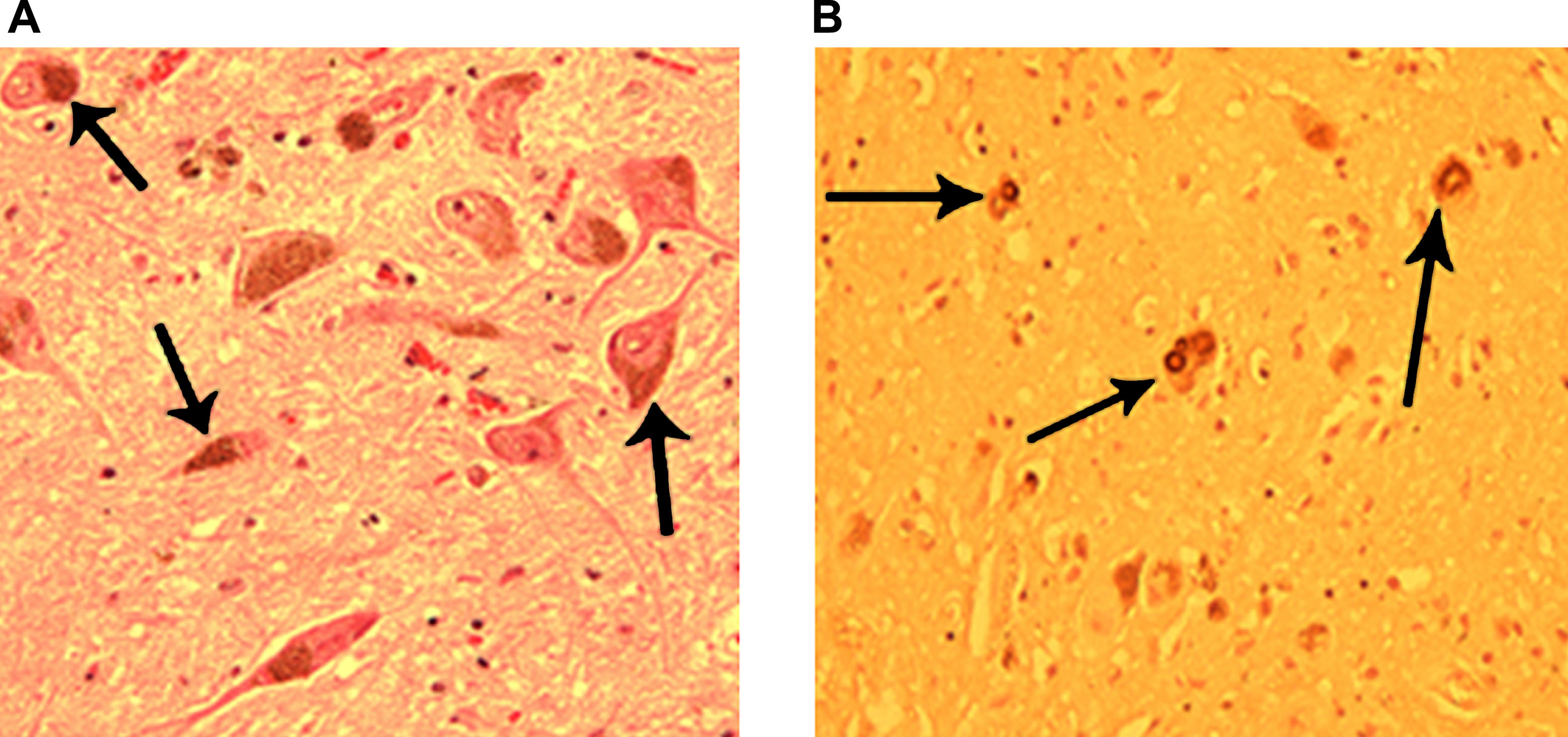 图3：正常和帕金森病患者的黑质。