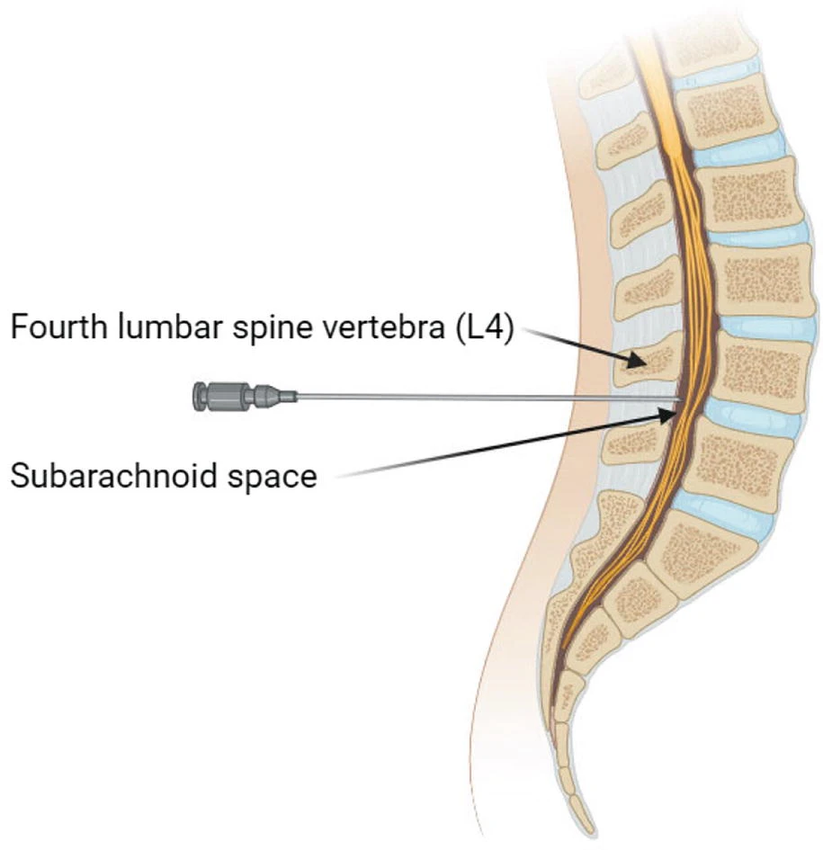 鞘内细胞输注 鞘内细胞输注