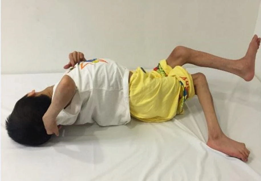 痉挛性脑瘫 痉挛性脑瘫