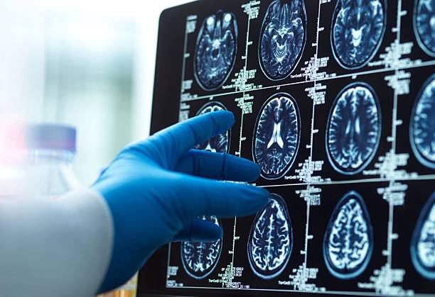 神经干细胞移植十大常见问题解答:从原理到术后护理全知道 神经干细胞移植十大常见问题解答:从原理到术后护理全知道