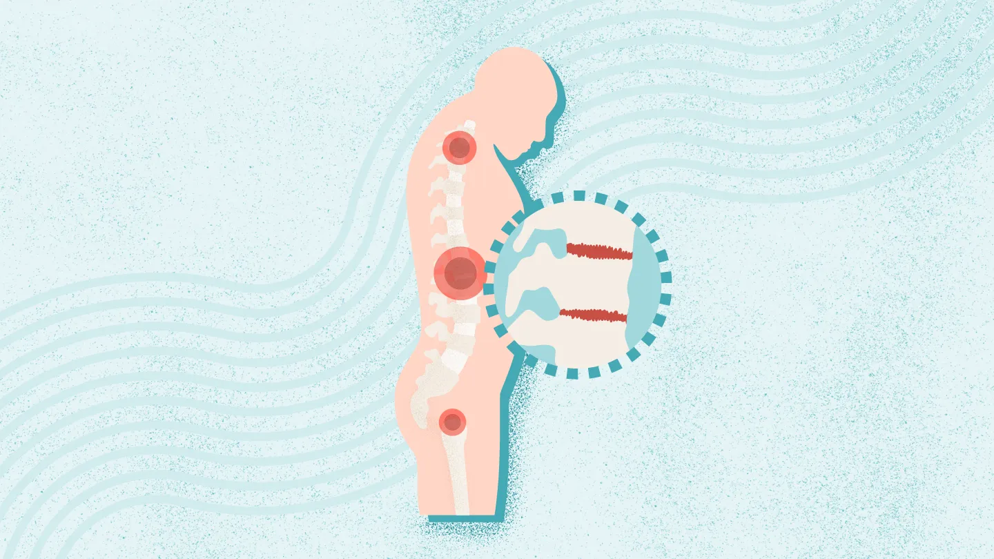 2025年干细胞治疗强直性脊柱炎最新临床进展（截至12月）