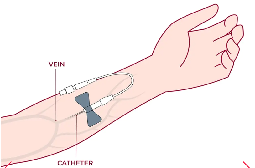 细胞通过静脉输注进行给药，在某些情况下，可以使用其他输送方法（例如鼻喷雾剂或局部应用）来针对特定系统。