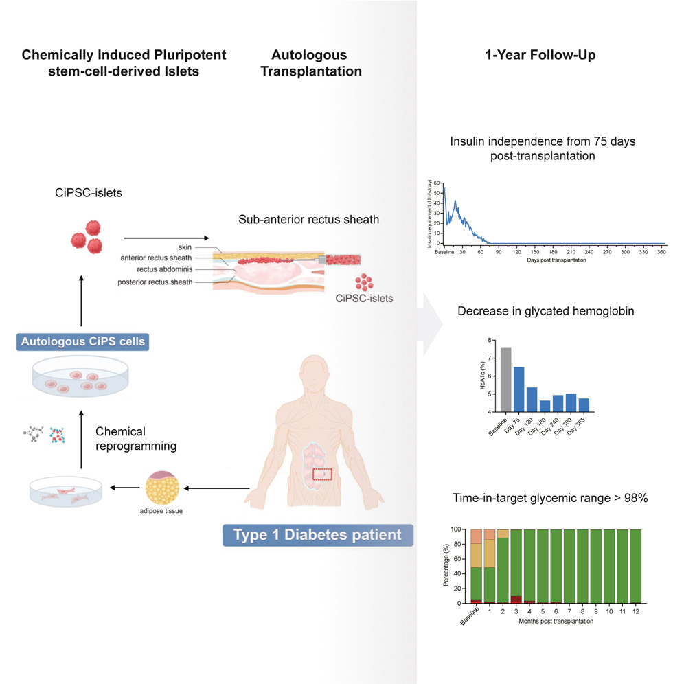 化学诱导多能干细胞衍生的胰岛自体移植一年随访