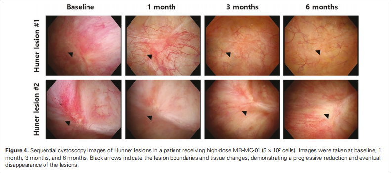 间质性膀胱炎临床试验 间质性膀胱炎临床试验