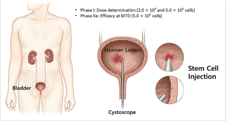 间质性膀胱炎临床试验 间质性膀胱炎临床试验