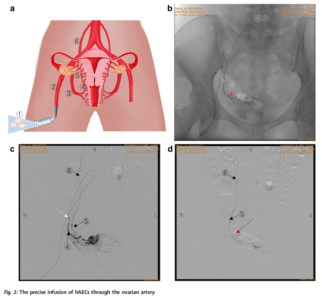 卵巢早衰临床试验