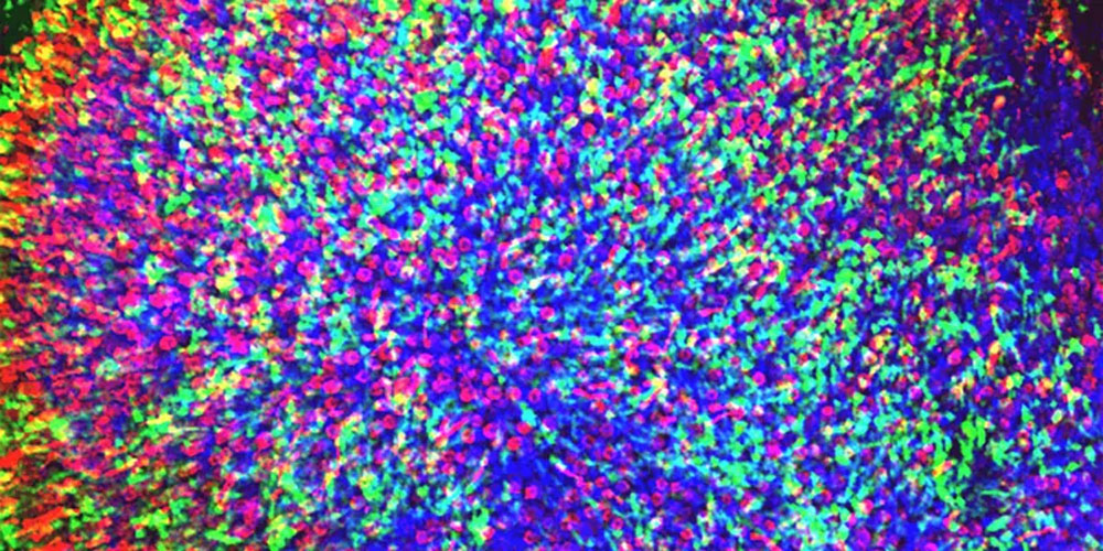 视网膜色素变性