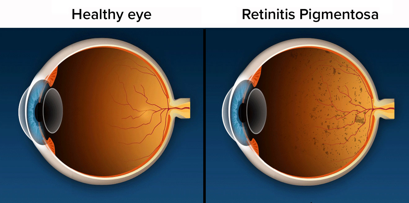 视网膜色素变性