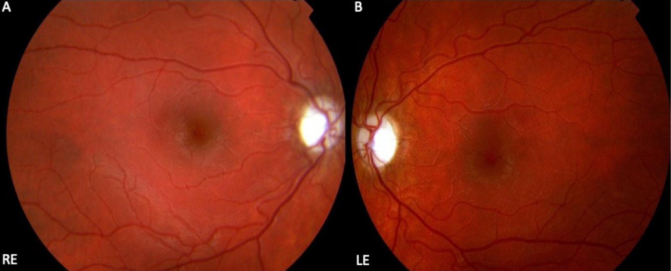 遗传性视神经病变