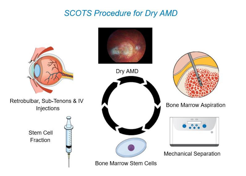 干细胞治疗年龄相关黄斑变性