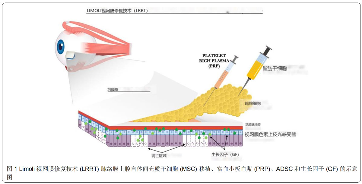 青光眼临床试验