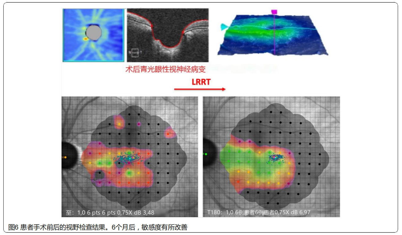 青光眼临床试验
