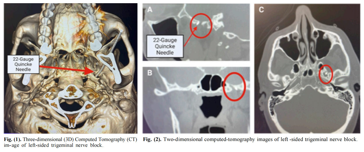 三叉神经痛临床试验