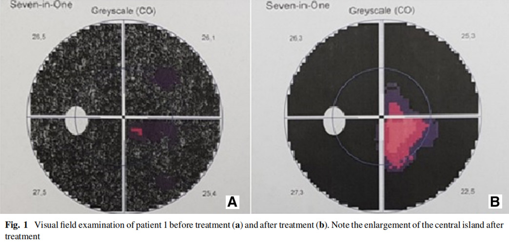 视神经萎缩临床试验