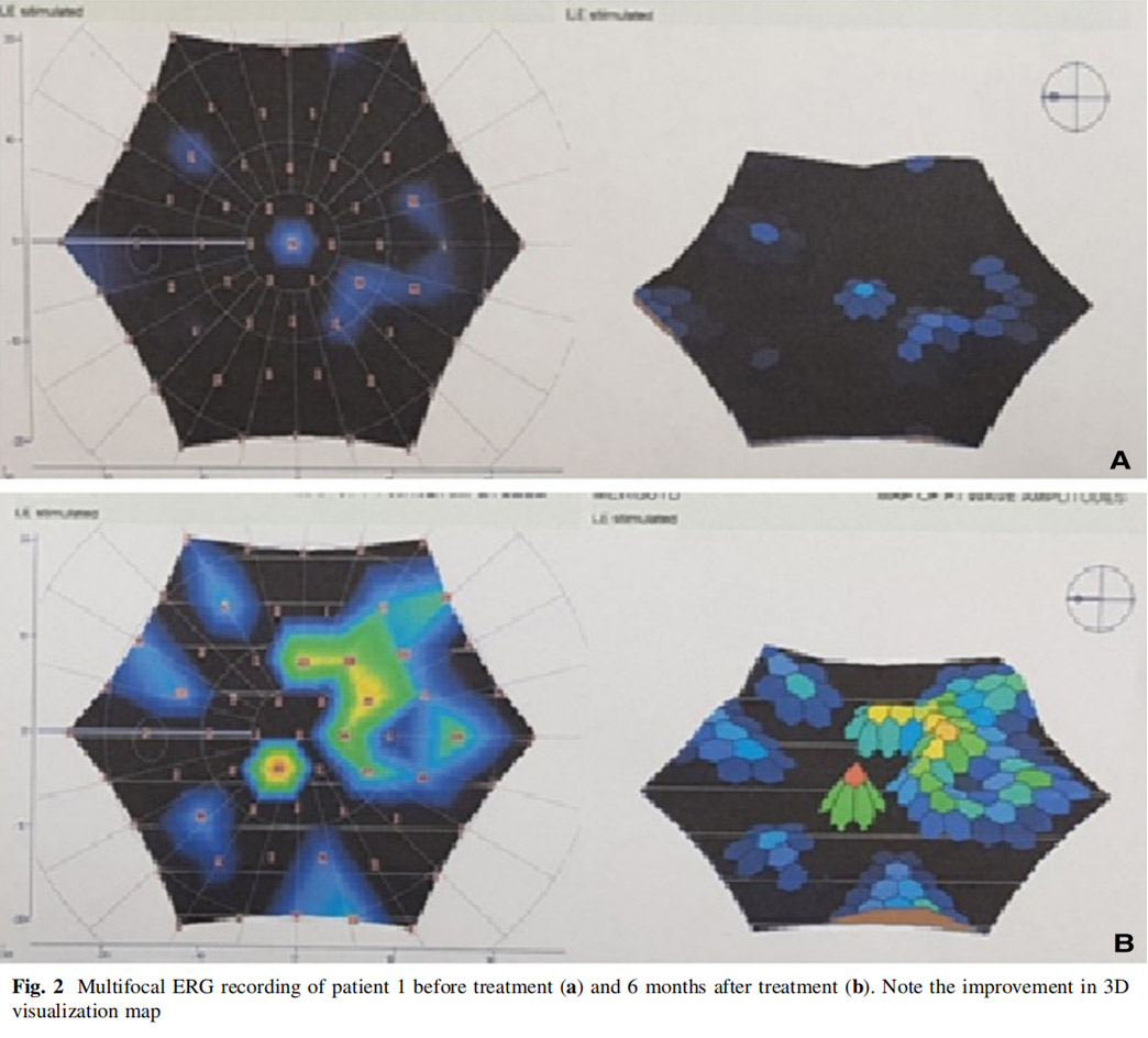 视神经萎缩临床试验
