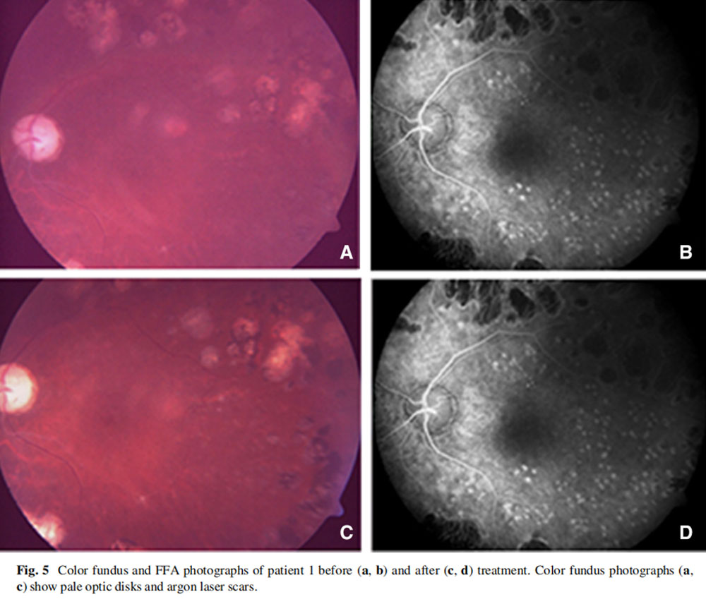 视神经萎缩临床试验