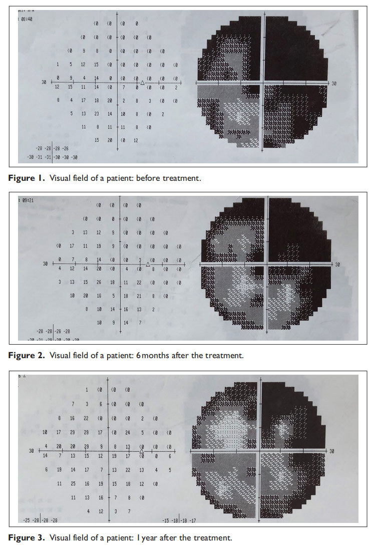 视神经萎缩临床试验