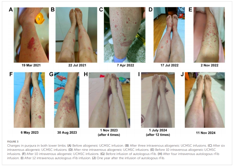 干燥综合征临床试验 干燥综合征临床试验