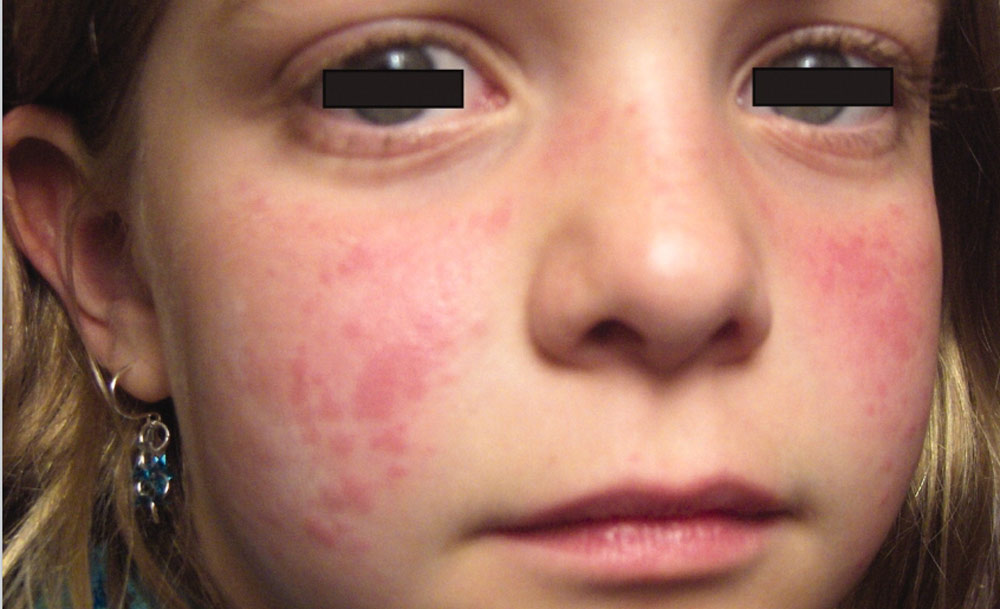 干细胞移植 干细胞移植