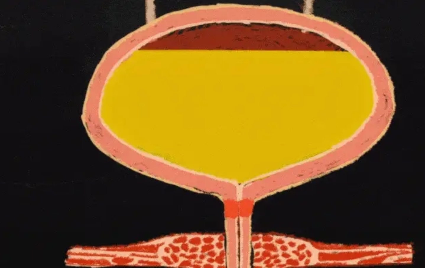 神经源性膀胱 神经源性膀胱