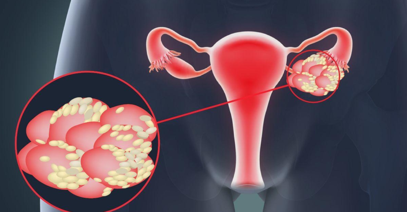 多囊卵巢综合征 多囊卵巢综合征