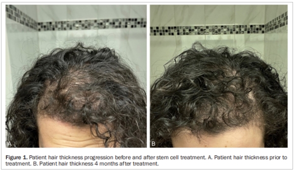 多囊卵巢综合征临床试验 多囊卵巢综合征临床试验