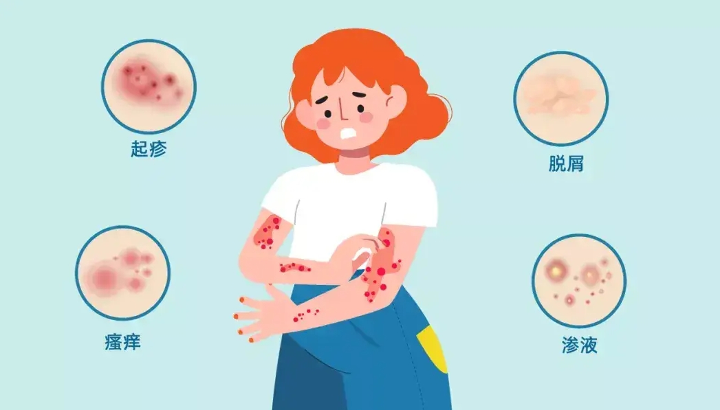 特应性皮炎 特应性皮炎