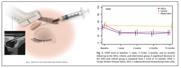 干细胞治疗 干细胞治疗