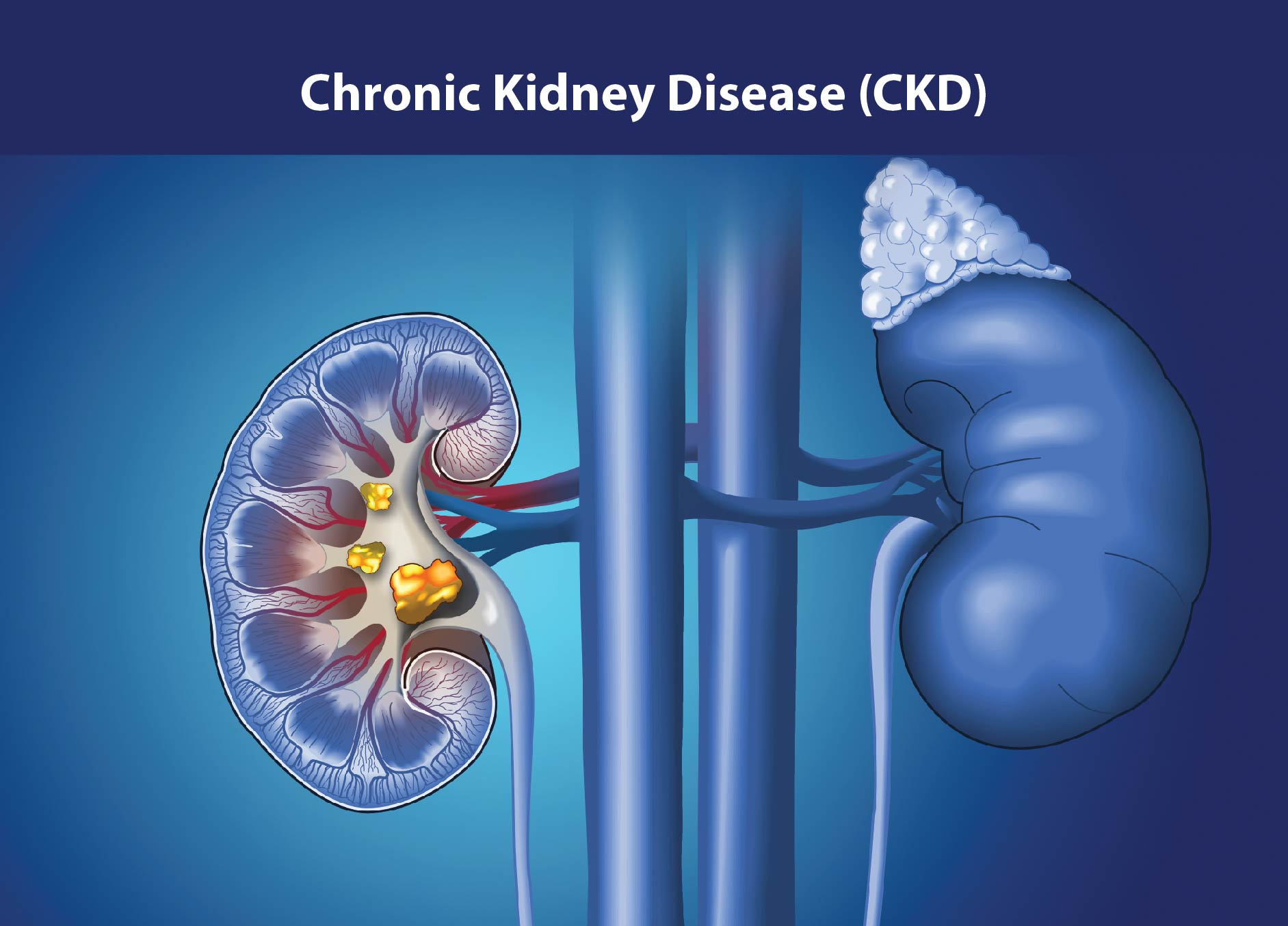 慢性肾病治疗新策略：间充质干细胞如何修复肾功能、延缓疾病进展？