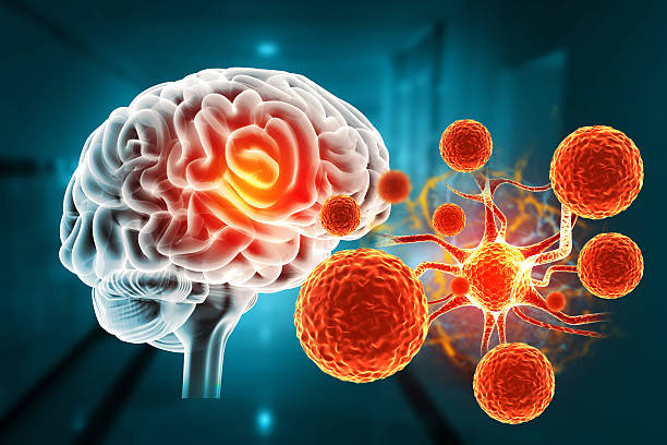 干细胞治疗帕金森病取得新进展！II期临床证实：三次输注，安全且运动功能得到改善