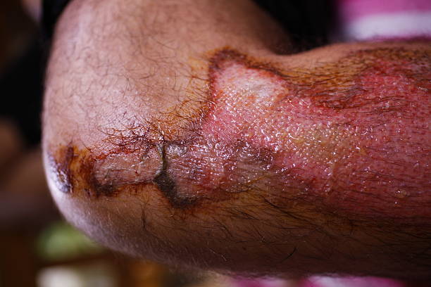 干细胞修复面部深度烧伤：1例患者术后面部基本恢复正常 | 成功案例