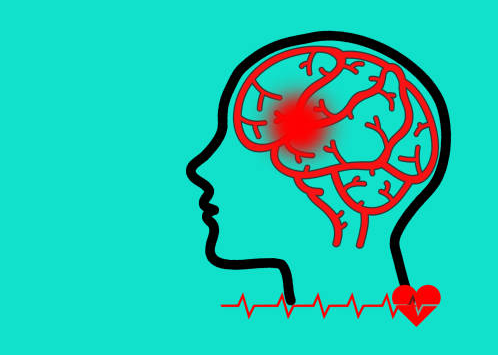 哪些中风患者适合干细胞治疗?专家公布了5大评估标准 哪些中风患者适合干细胞治疗?专家公布了5大评估标准