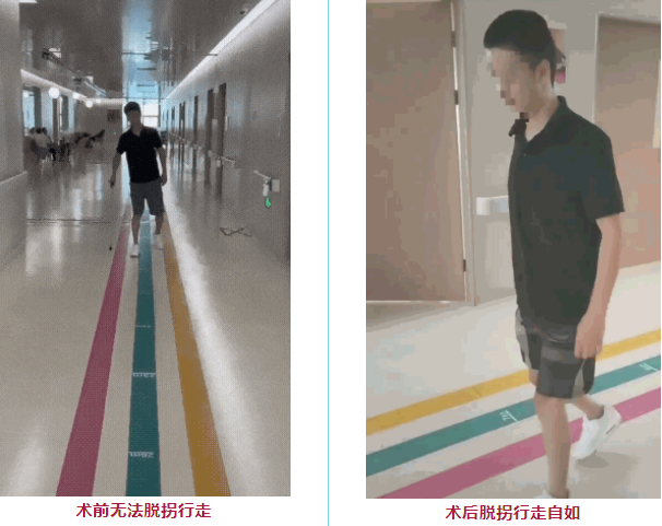 干细胞治疗脊髓损伤患者