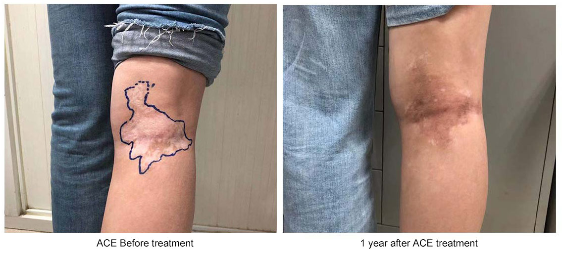 干细胞移植前后白癜风症状改变