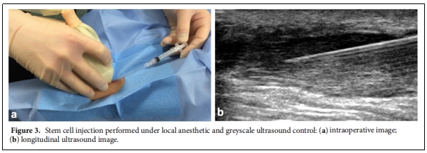 图3.在局部麻醉和灰阶超声控制下进行的干细胞注射 图3.在局部麻醉和灰阶超声控制下进行的干细胞注射